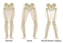 kneevarus