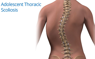 scoliosis